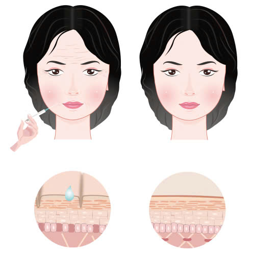 uu-va-nhuoc-diem-cua-tiem-botox-hieu-dung-de-lam-dep-an-toan