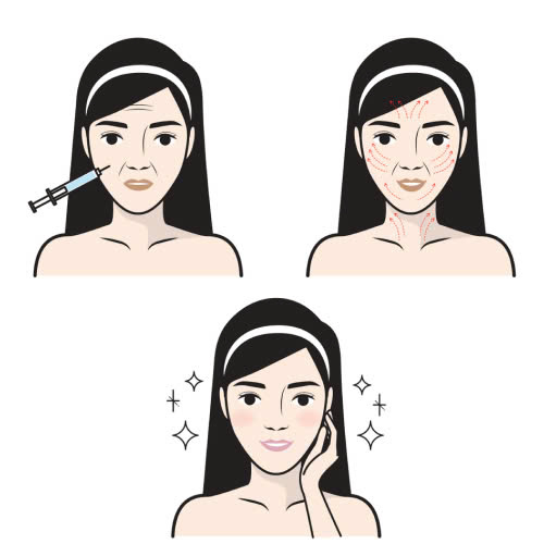 dang-cho-con-bu-tiem-filler-duoc-khong-giai-dap-chi-tiet-cho-me-bim-sua