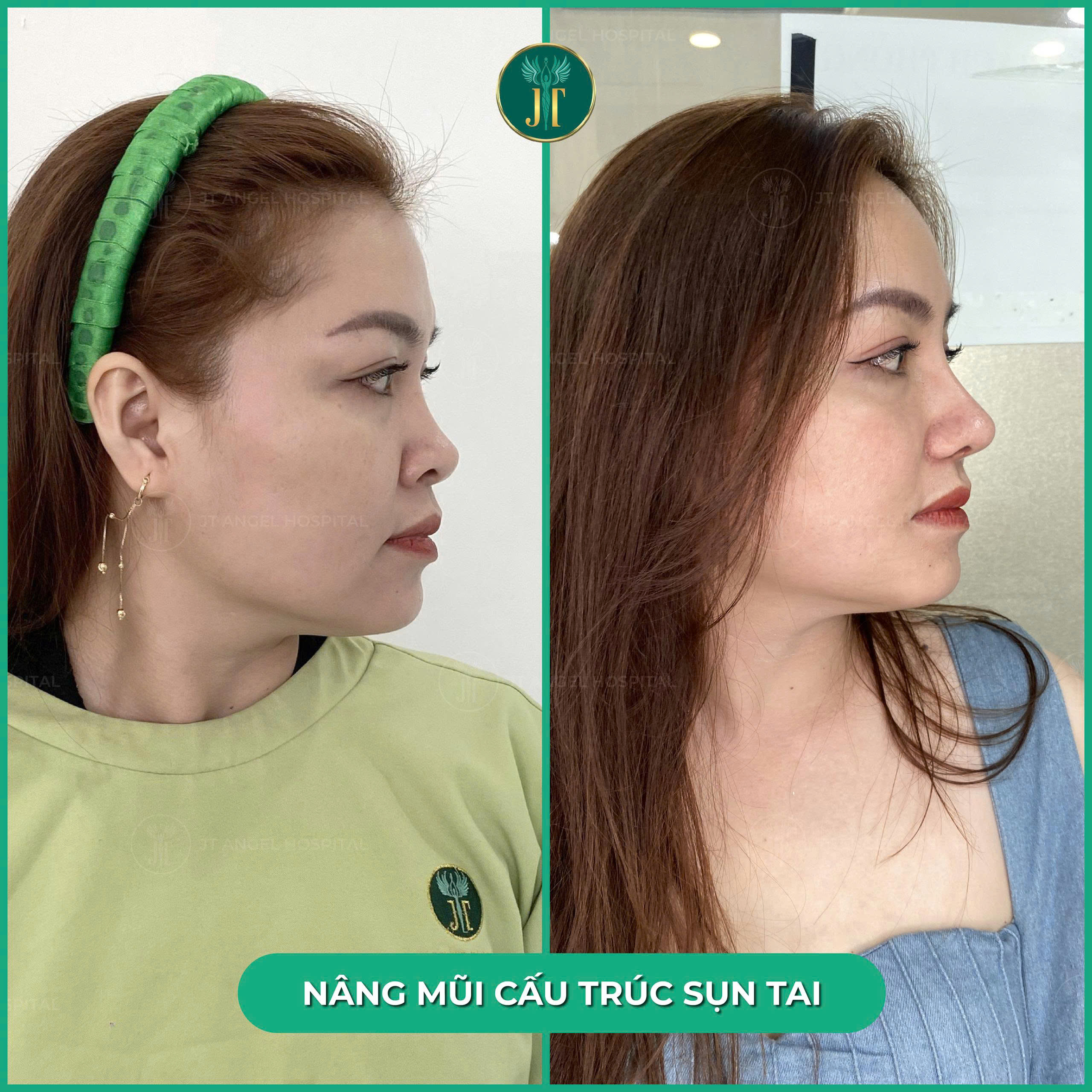nang-mui-cau-truc-sun-tai-o-dau-tot-bat-mi-bi-quyet-chon-dung-noi-chon-mat-gui-vang