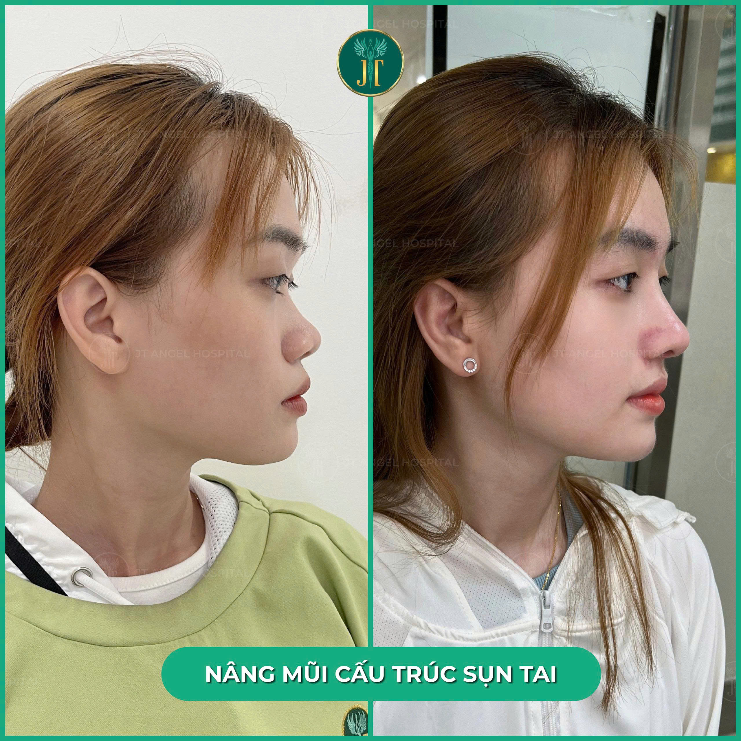 nang-mui-cau-truc-sun-tai-o-dau-tot-bat-mi-bi-quyet-chon-dung-noi-chon-mat-gui-vang