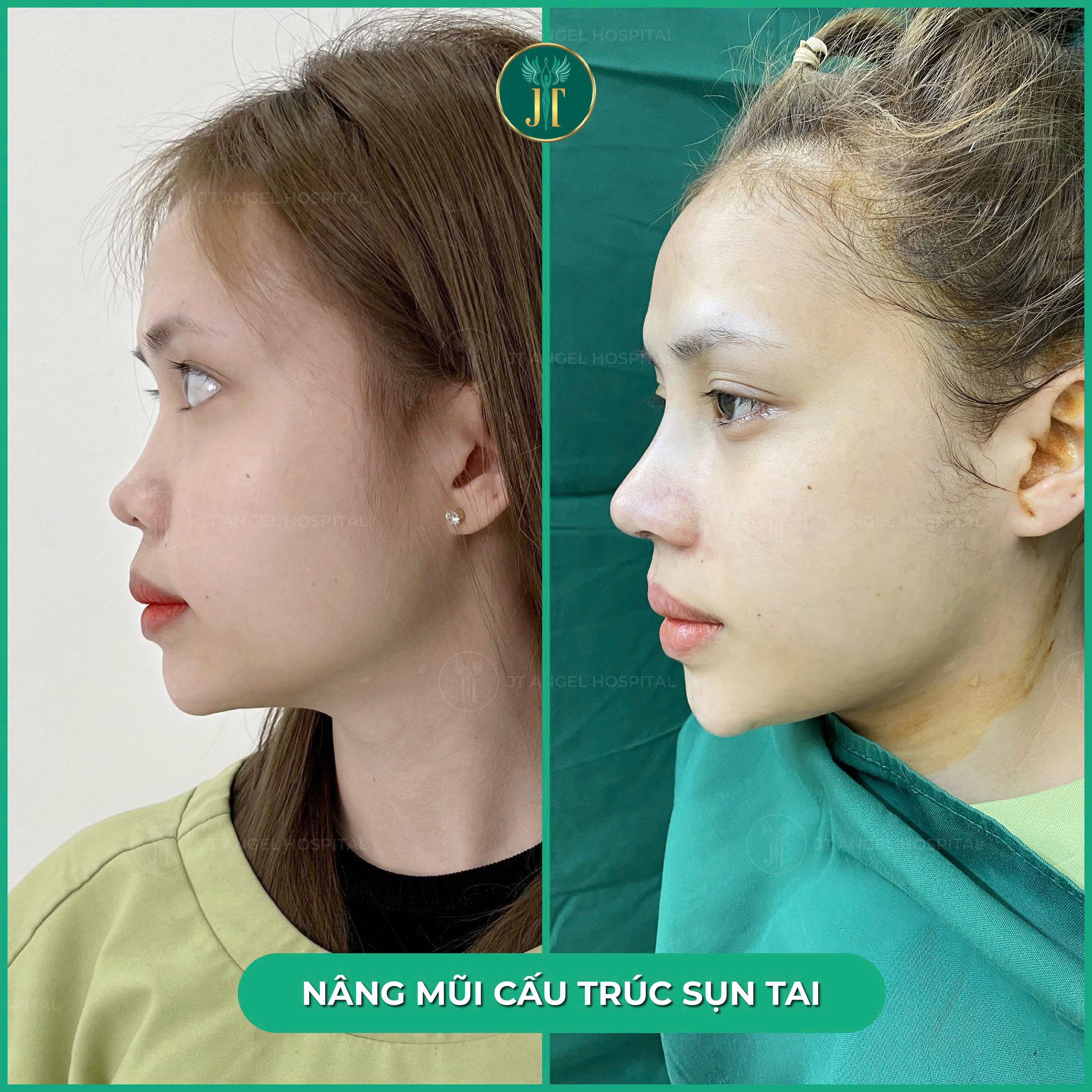 bi-quyet-chon-noi-nang-mui-cau-truc-sun-tai-uy-tin-tphcm-ma-ban-khong-nen-bo-lo