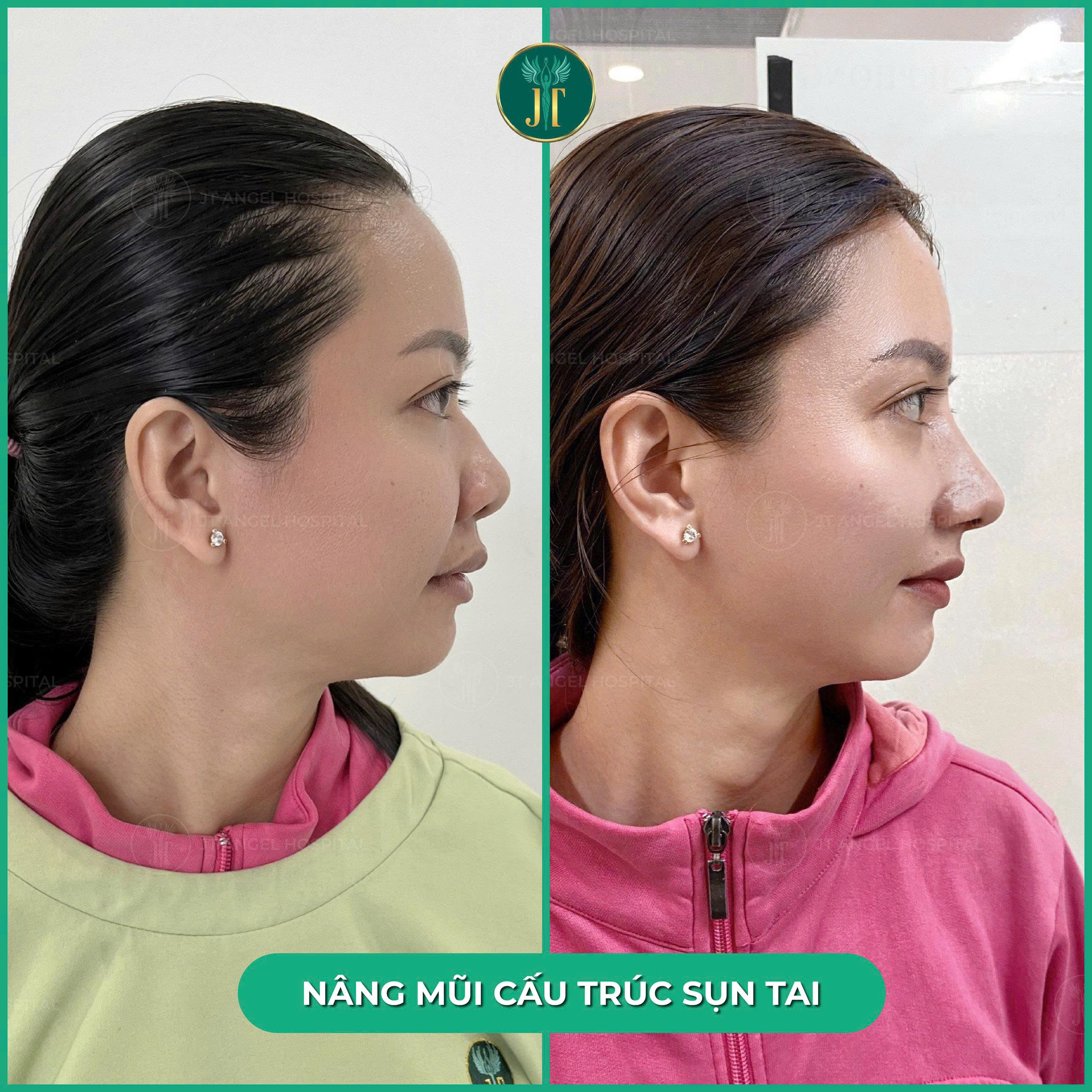 bi-quyet-chon-noi-nang-mui-cau-truc-sun-tai-uy-tin-tphcm-ma-ban-khong-nen-bo-lo