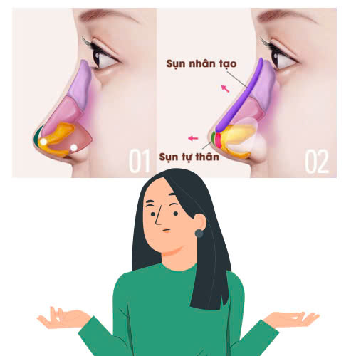 nang-mui-cau-truc-va-nang-mui-boc-sun-cai-nao-tot-hon-so-sanh-thuc-te-giup-ban-hieu-ro-hon