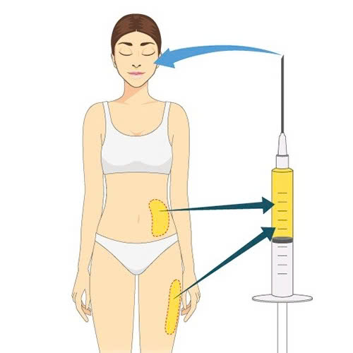 nen-cay-mo-tu-than-hay-tiem-filler-giai-phap-nao-tot-hon