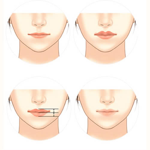 nhung-dang-moi-tiem-filler-dep-va-pho-bien-hien-nay