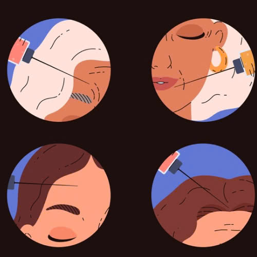 phan-ung-sau-khi-tiem-filler-dau-hieu-binh-thuong-va-nguy-hiem-can-luu-y