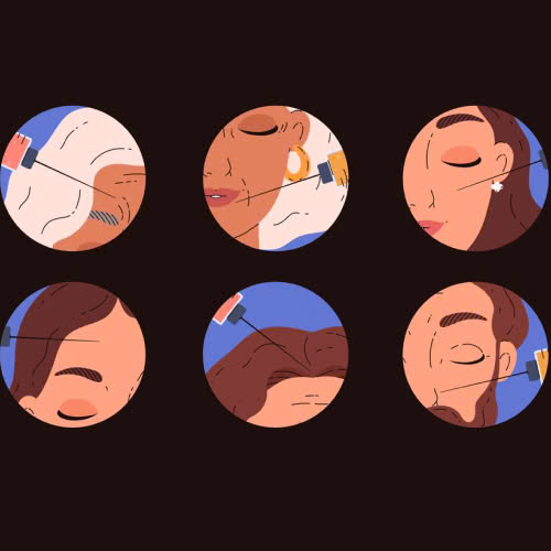 tiem-filler-bao-lau-thi-tan-giai-dap-tu-a-z