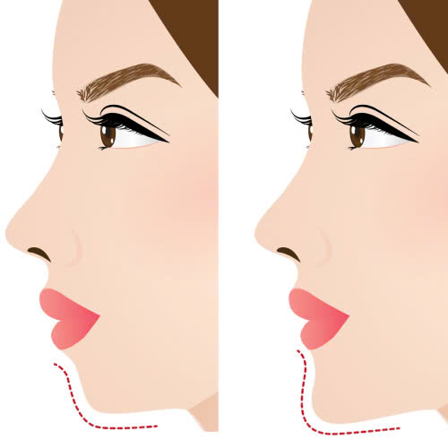 tiem-filler-cam-gia-bao-nhieu-bang-gia-moi-nhung-dieu-can-biet