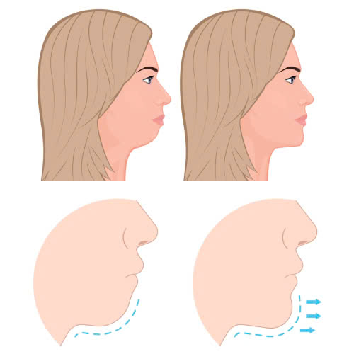 tiem-filler-cam-gia-bao-nhieu-bang-gia-moi-nhung-dieu-can-biet