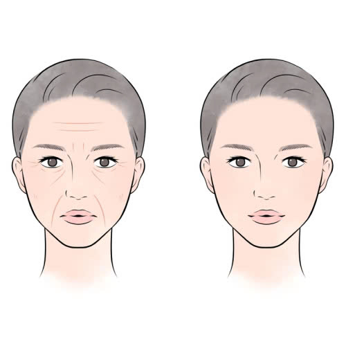 tiem-filler-co-hai-ve-sau-khong-su-that-ban-can-biet-truoc-khi-tiem