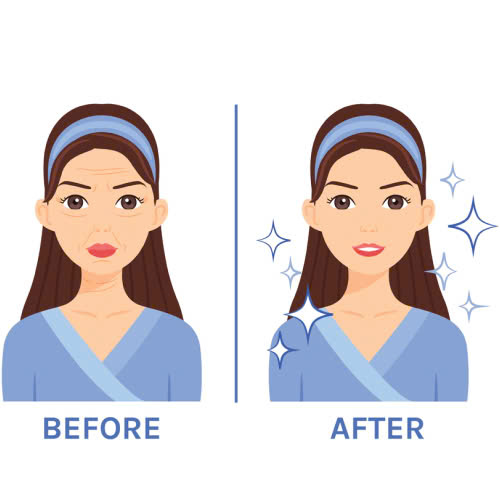 tiem-filler-giu-duoc-bao-lau-nhung-yeu-to-anh-huong-den-hieu-qua-filler