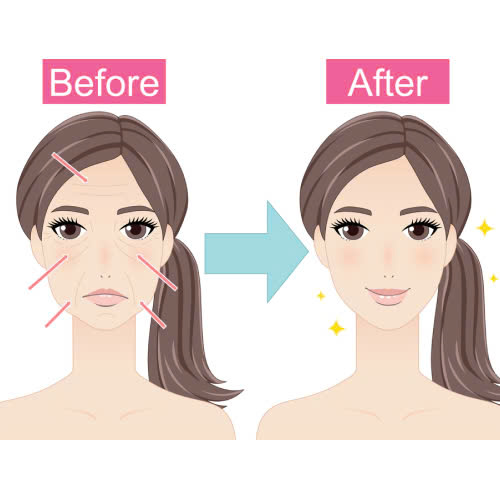 tiem-filler-lau-dai-co-anh-huong-gi-khong-nhung-dieu-can-biet-truoc-khi-thuc-hien