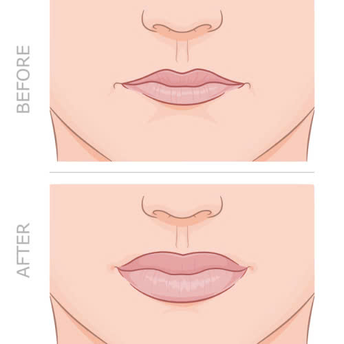 tiem-filler-moi-1cc-gia-bao-nhieu-tat-tan-tat-nhung-dieu-ban-can-biet