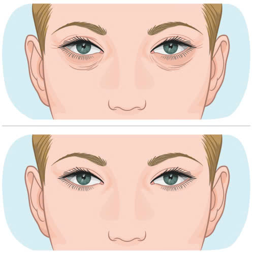 tiem-filler-quang-tham-mat-gia-bao-nhieu-giai-dap-chi-tiet-va-nhung-dieu-can-biet