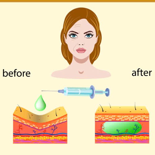 tiem-filler-sau-1-thang-bi-sung-nguyen-nhan-cach-xu-ly-va-phong-tranh-hieu-qua
