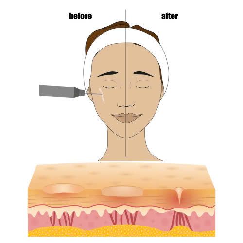 tiem-filler-seo-lom-giai-phap-hieu-qua-cho-lan-da-nhu-y