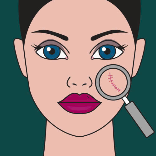 tiem-filler-seo-lom-giai-phap-hieu-qua-cho-lan-da-nhu-y