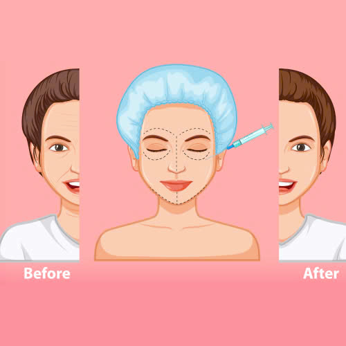 tiem-filler-xong-bi-cung-nguyen-nhan-cach-khac-phuc-phong-tranh-hieu-qua