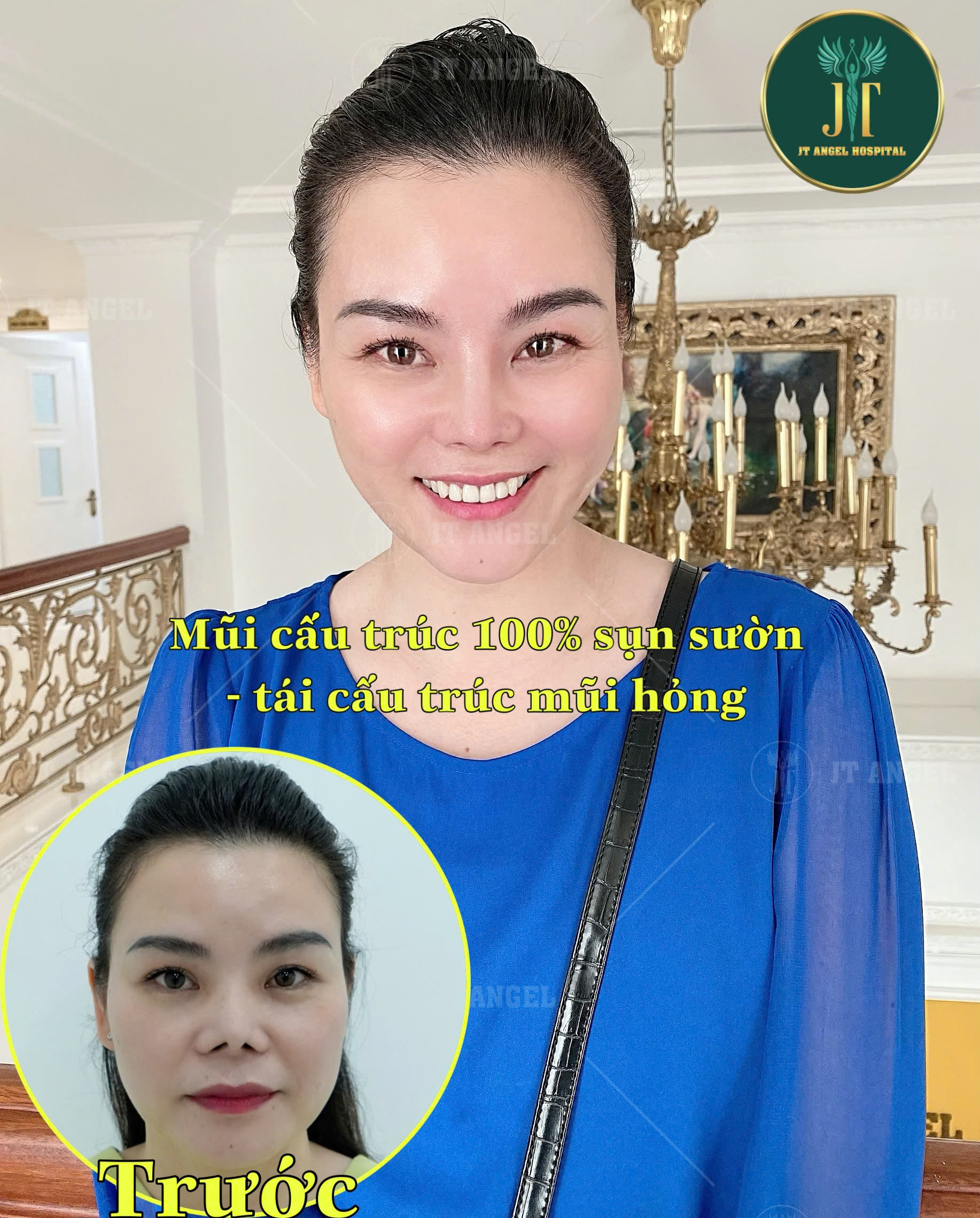 hinh-anh-truoc-va-sau-nang-mui-sun-suon-su-thay-doi-ngoan-muc-khien-ban-khong-the-roi-mat