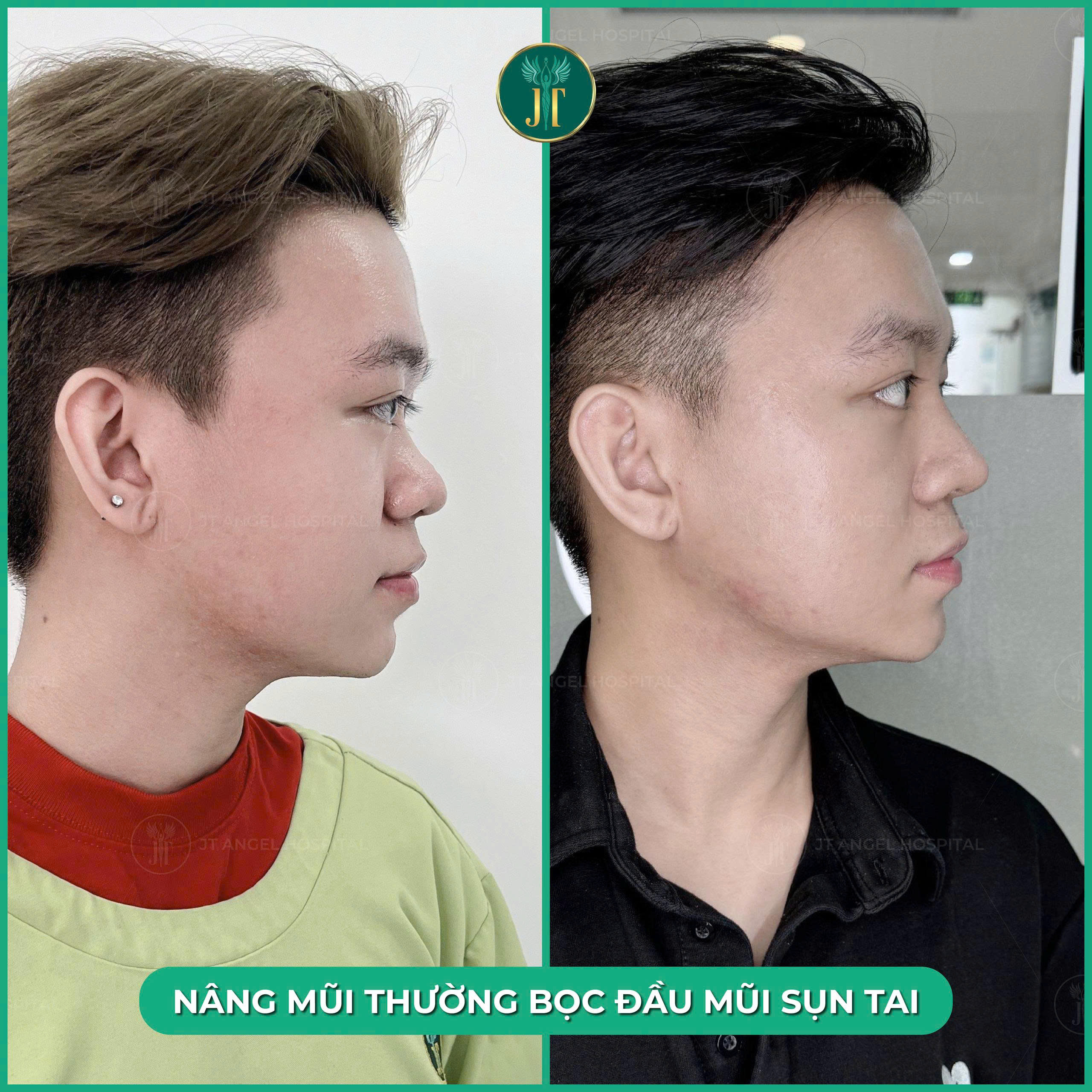 hinh-anh-truoc-va-sau-nang-mui-sun-thuong-tim-hieu-ky-truoc-khi-quyet-dinh