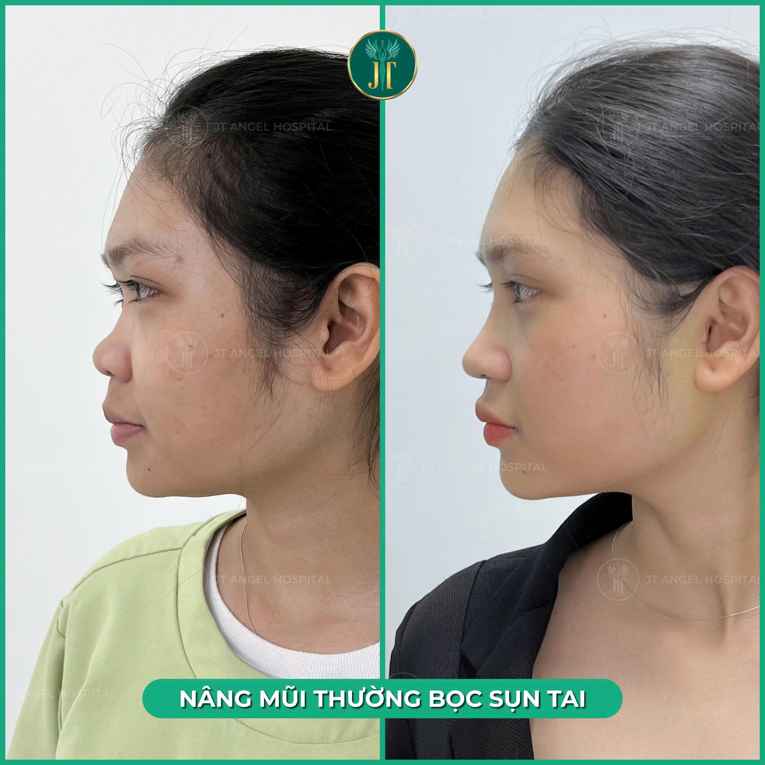 hinh-anh-truoc-va-sau-nang-mui-sun-thuong-tim-hieu-ky-truoc-khi-quyet-dinh