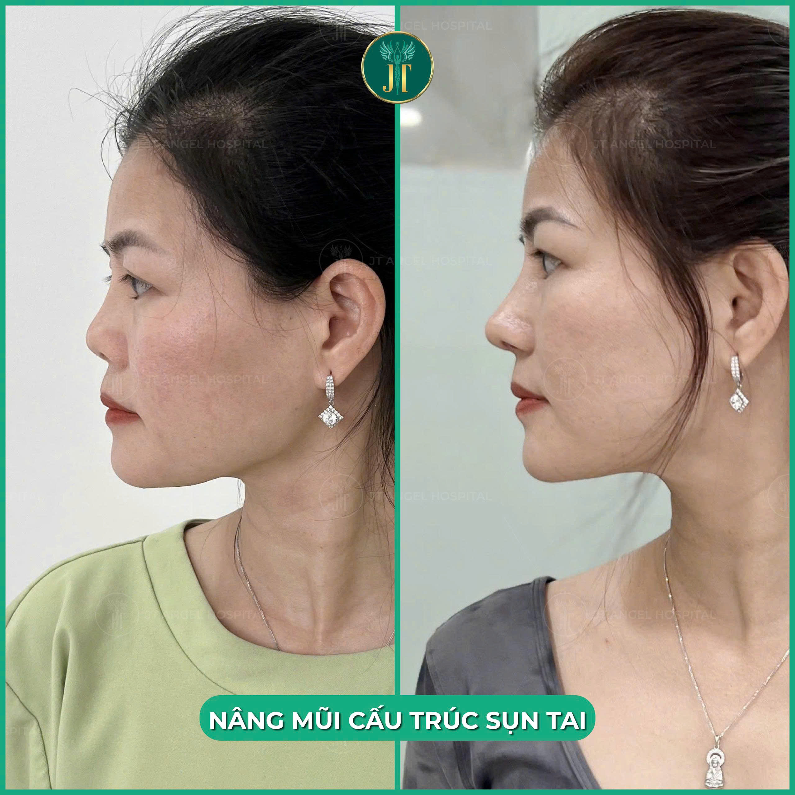 hinh-anh-truoc-va-sau-nang-mui-sun-tu-than-bang-chung-ro-rang-cho-mot-dien-mao-moi