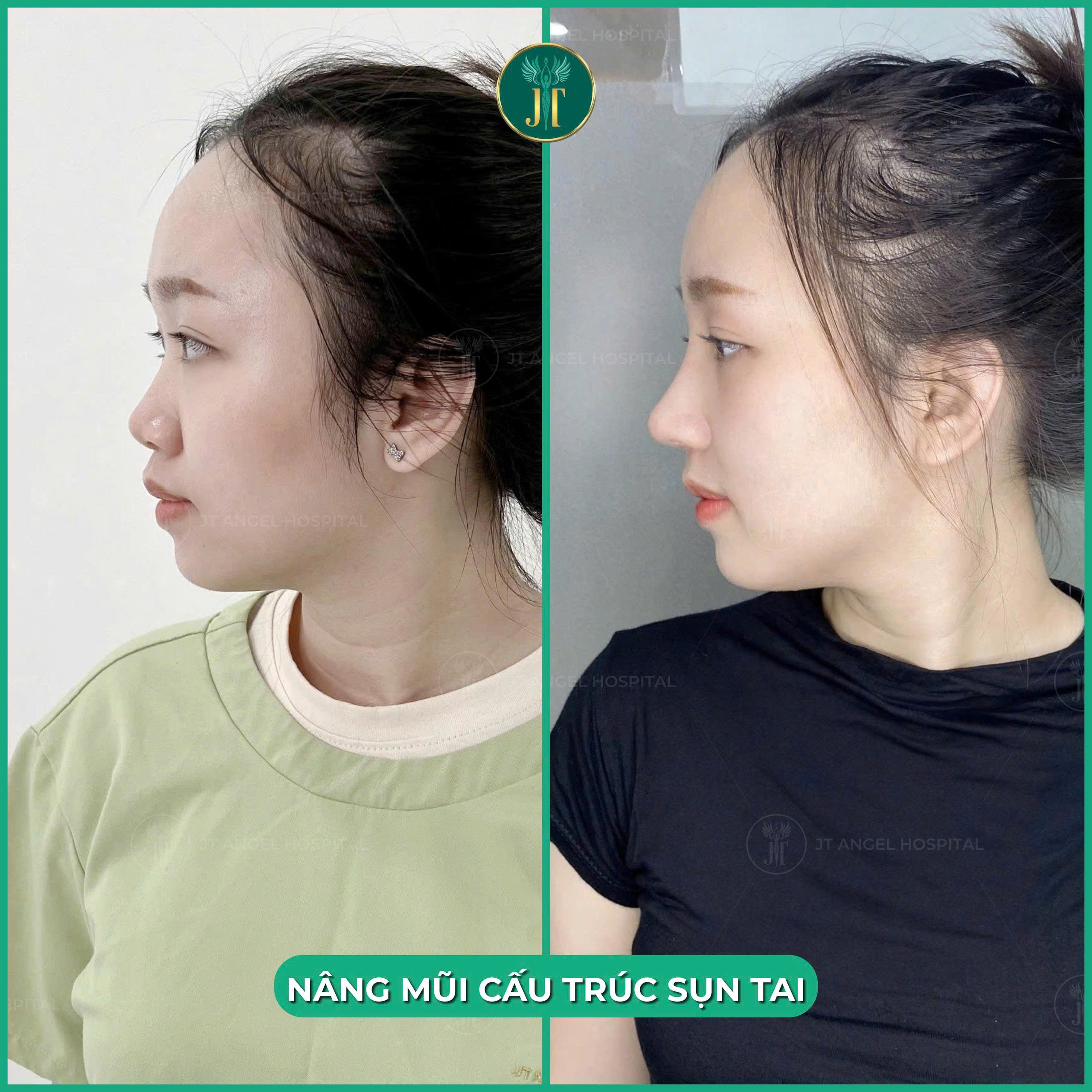 hinh-anh-truoc-va-sau-nang-mui-sun-tu-than-bang-chung-ro-rang-cho-mot-dien-mao-moi