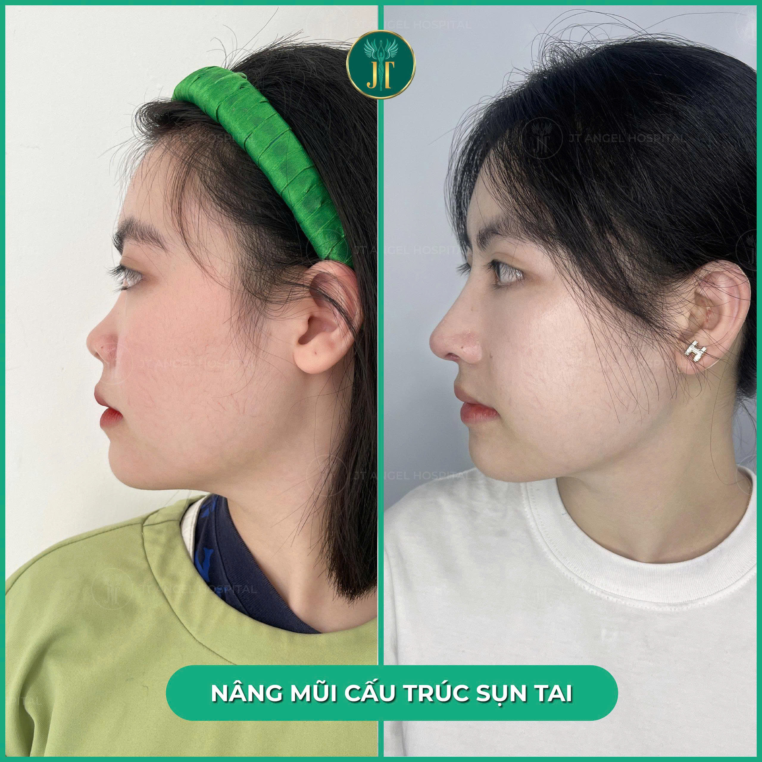 hinh-anh-truoc-va-sau-nang-mui-sun-tu-than-bang-chung-ro-rang-cho-mot-dien-mao-moi