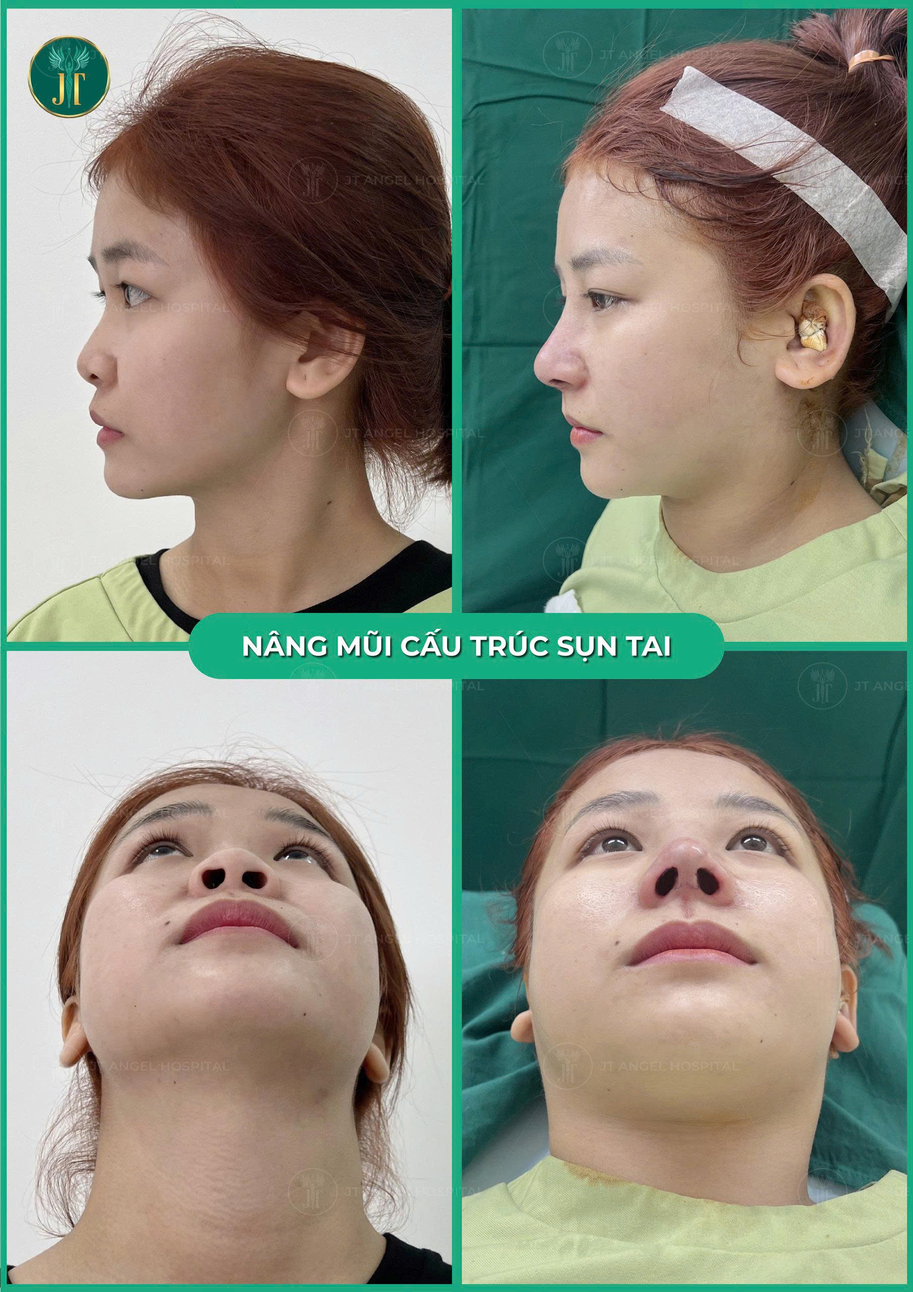 hinh-anh-truoc-va-sau-thu-nho-dau-mui-ket-qua-bat-ngo-khien-ai-cung-muon-lam-ngay