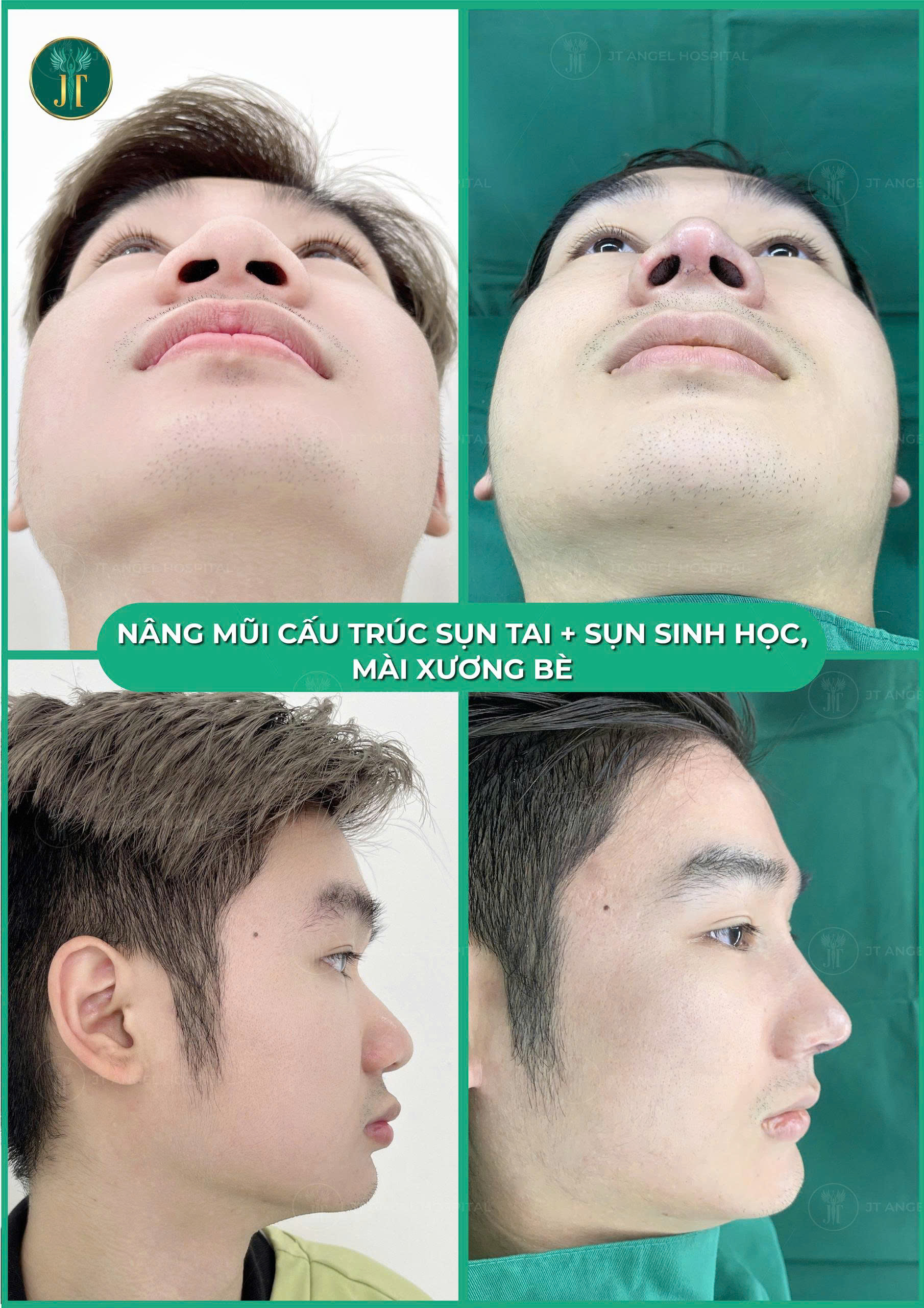 hinh-anh-truoc-va-sau-thu-nho-dau-mui-ket-qua-bat-ngo-khien-ai-cung-muon-lam-ngay