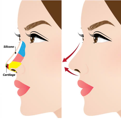 Sự thật bất ngờ: Nâng mũi bán cấu trúc có đau không như bạn nghĩ?