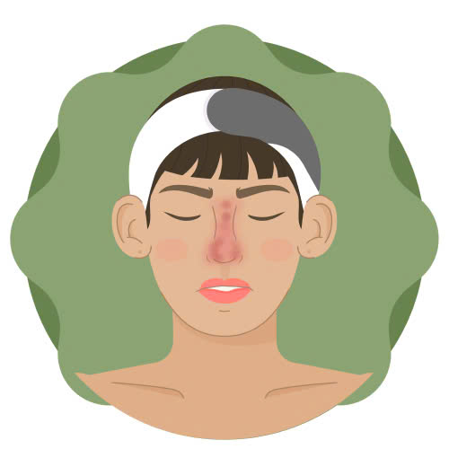 nang-mui-sun-thuong-bi-hong-nguyen-nhan-va-cach-khac-phuc-an-toan-hieu-qua