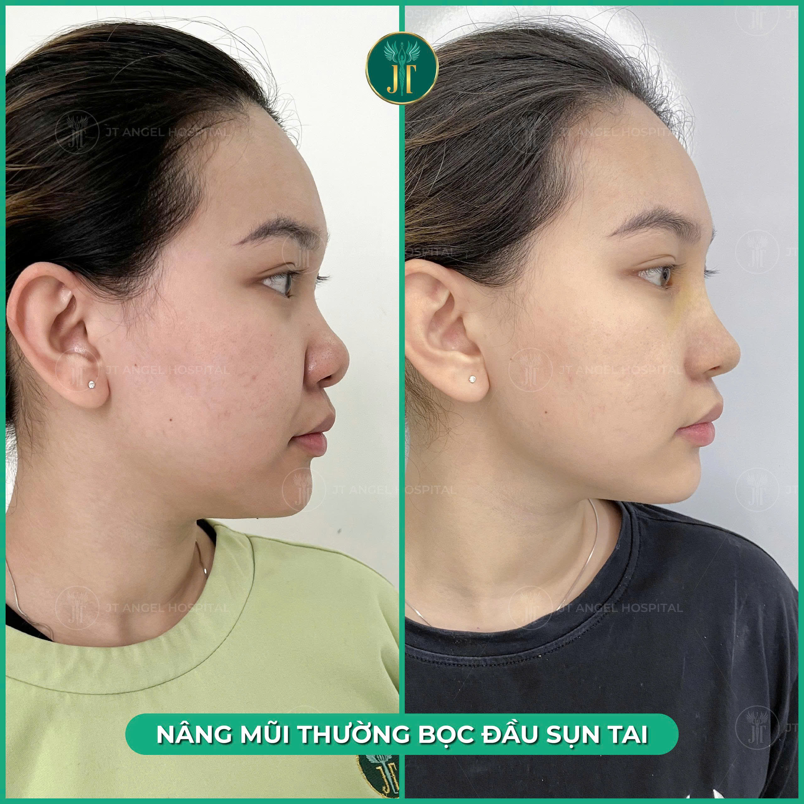 hinh-anh-truoc-va-sau-nang-mui-ban-cau-truc-khien-ai-cung-bat-ngo