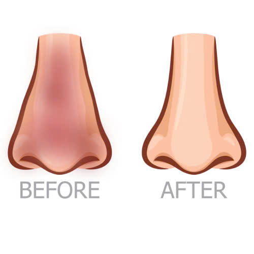 sau-khi-thuc-hien-nao-silicone-mui-co-can-su-dung-thuoc-gi-khong