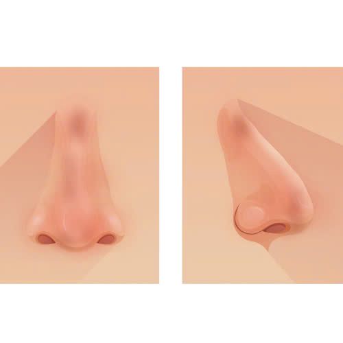nao-silicone-mui-phuong-phap-nao-hieu-qua-khi-mui-bi-bien-chung-do-tiem-silicone