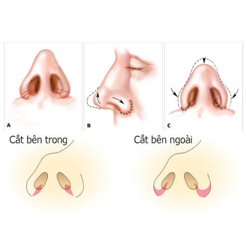 thu-gon-canh-mui-co-anh-huong-den-ho-hap-khong-su-that-ban-can-biet-truoc-khi-lam-dep