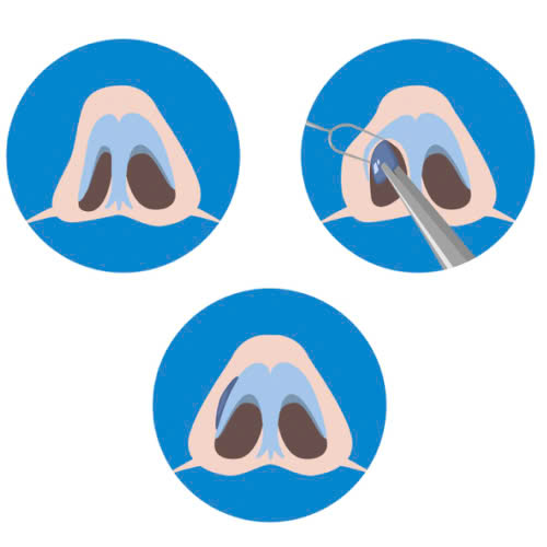 can-chinh-canh-mui-gia-bao-nhieu-lieu-co-dang-de-dau-tu