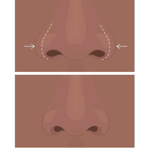 can-chinh-canh-mui-khong-phau-thuat-bi-quyet-so-huu-dang-mui-thon-gon-khong-can-dao-keo