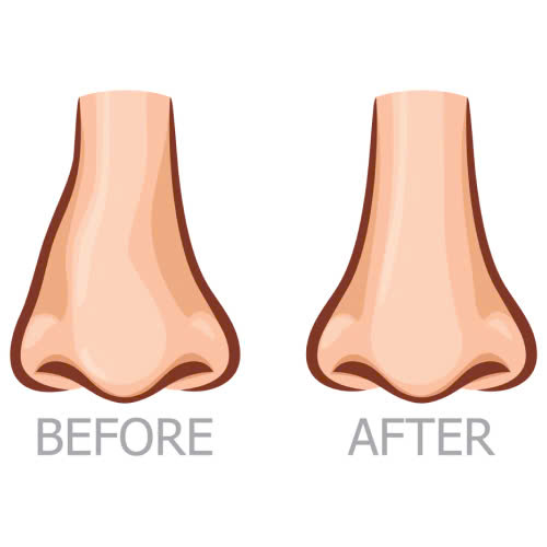 can-chinh-canh-mui-khong-phau-thuat-bi-quyet-so-huu-dang-mui-thon-gon-khong-can-dao-keo