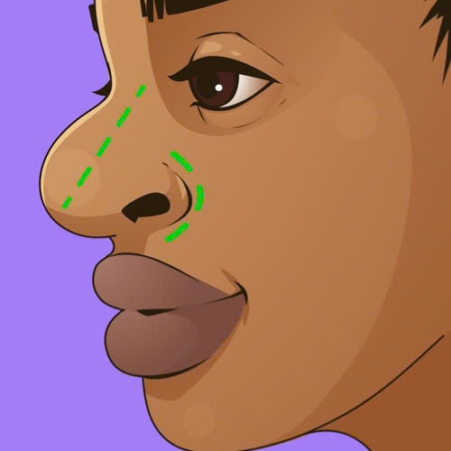 can-chinh-canh-mui-la-gi-giai-phap-tham-my-giup-guong-mat-hai-hoa-va-thanh-thoat-hon