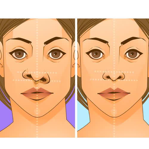 can-chinh-canh-mui-la-gi-giai-phap-tham-my-giup-guong-mat-hai-hoa-va-thanh-thoat-hon