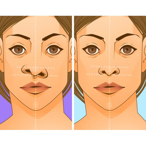 chinh-hinh-mui-di-tat-giai-phap-khoi-phuc-tu-tin-va-can-doi-khuon-mat