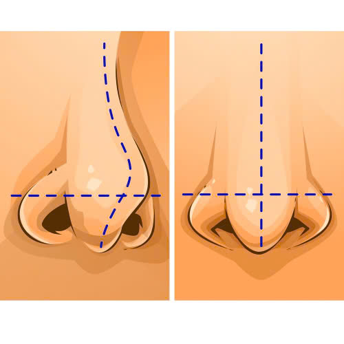 chinh-hinh-mui-di-tat-giai-phap-khoi-phuc-tu-tin-va-can-doi-khuon-mat