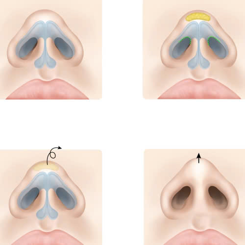 filler-lam-day-hom-dau-mui-giu-duoc-bao-lau-nhung-yeu-to-anh-huong-ban-can-biet