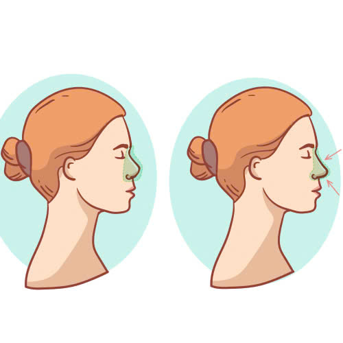 filler-lam-day-hom-dau-mui-giu-duoc-bao-lau-nhung-yeu-to-anh-huong-ban-can-biet