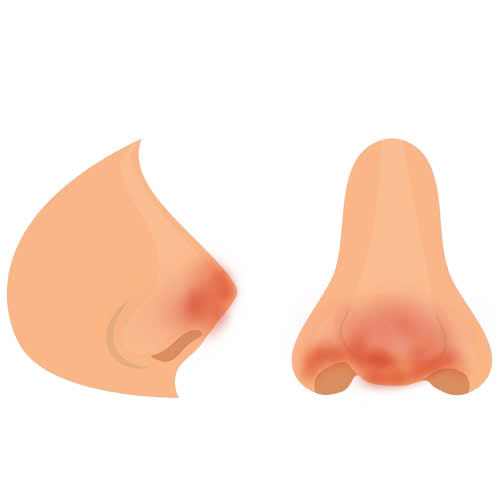 nao-silicone-mui-co-dau-khong-nhung-dieu-ai-cung-nen-biet-truoc-khi-quyet-dinh