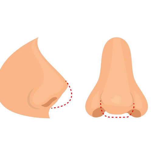 tiem-filler-hom-dau-mui-giai-phap-tham-my-khong-phau-thuat-duoc-ua-chuong-hien-nay