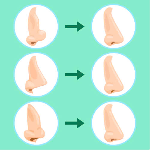 tiem-filler-hom-dau-mui-giai-phap-tham-my-khong-phau-thuat-duoc-ua-chuong-hien-nay