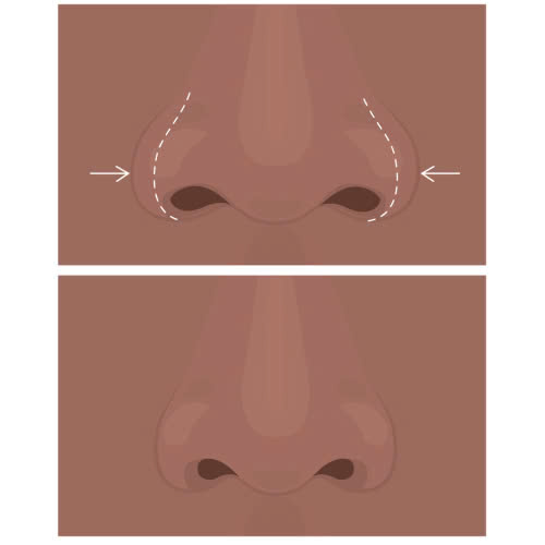 can-chinh-canh-mui-bao-lau-thi-lanh-giai-dap-chi-tiet-tu-a-den-z-cho-nguoi-moi