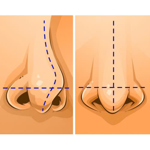 can-chinh-canh-mui-bi-veo-bi-quyet-lay-lai-dang-mui-can-doi-khong-can-chinh-sua-nhieu
